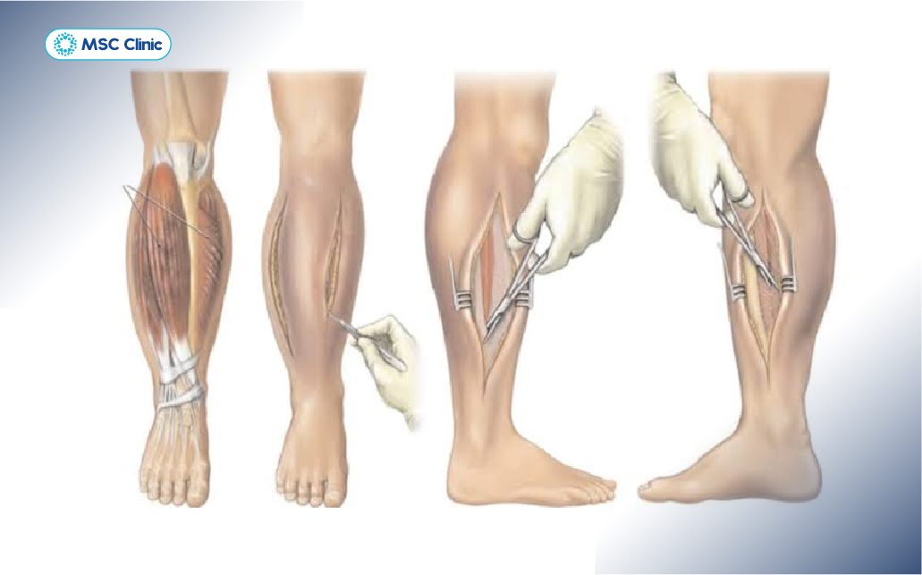 Phẫu thuật mở gân khoang giúp mở đường cho máu lưu thông trở lại tức thì