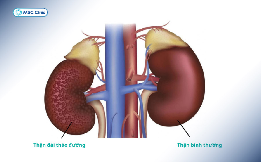 Dù là nước cam nguyên chất, người bệnh tiểu đường có biến chứng thận vẫn cần thận trọng khi sử dụng