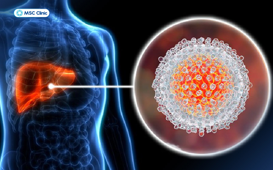 Viêm gan C là một bệnh lý về gan gây ra bởi virus HCV