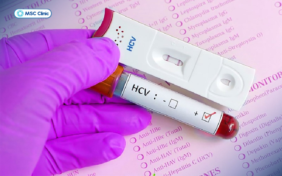 Anti-HCV âm tính chưa loại trừ nhiễm HCV nếu xét nghiệm quá sớm