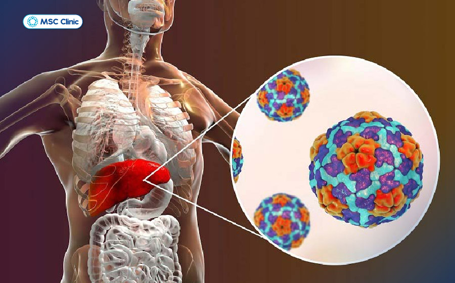 Viêm gan A cần được nhận biết và chăm sóc đúng cách Viêm gan A cần được nhận biết và chăm sóc đúng cách