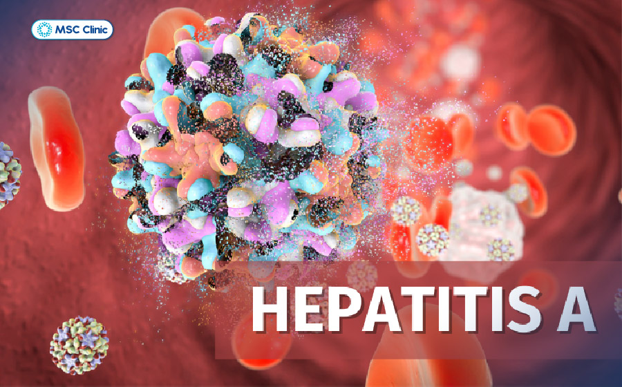 Viêm gan A do Hepatitis A virus - HAV gây ra