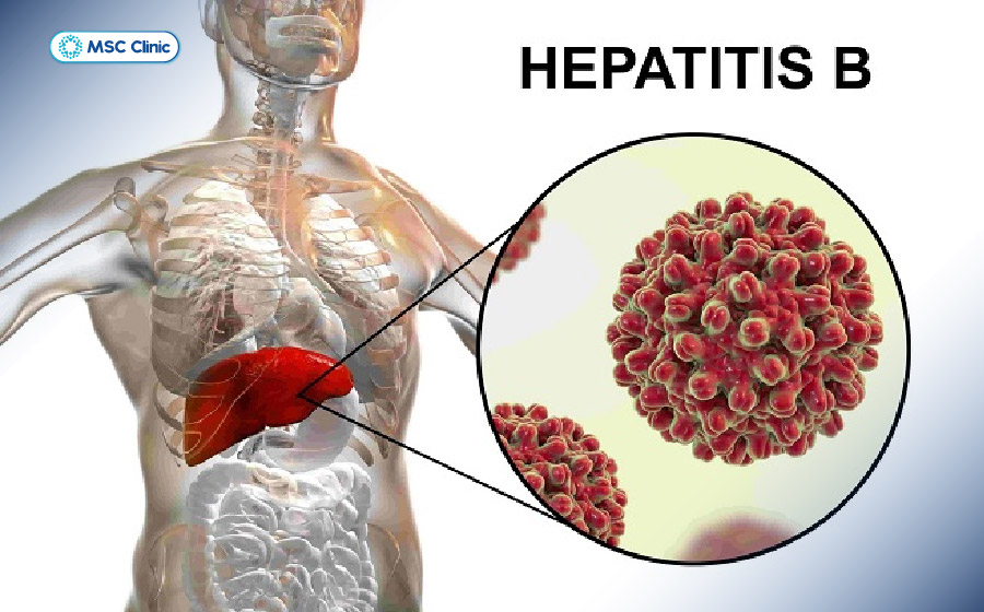 Viêm gan B cấp tính xảy ra trong giai đoạn đầu sau khi cơ thể nhiễm virus HBV
