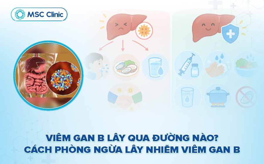 Viêm gan B lây qua đường nào? Cách phòng ngừa lây nhiễm viêm gan B
