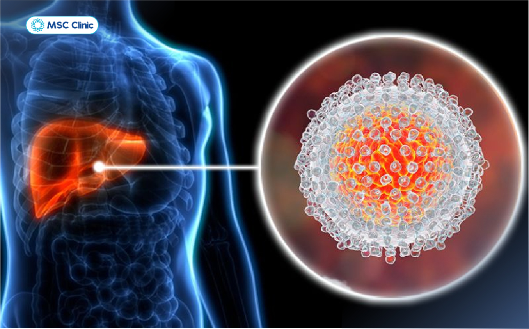 Viêm gan C do virus HCV - Hepatitis C gây ra