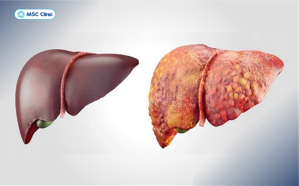 Viêm gan C có thể dẫn tới biến chứng xơ gan