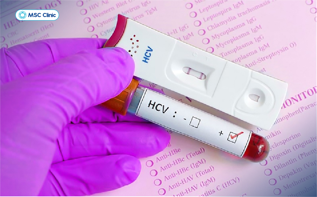Xét nghiệm kháng thể HCV xác định tiếp xúc với virus viêm gan C
