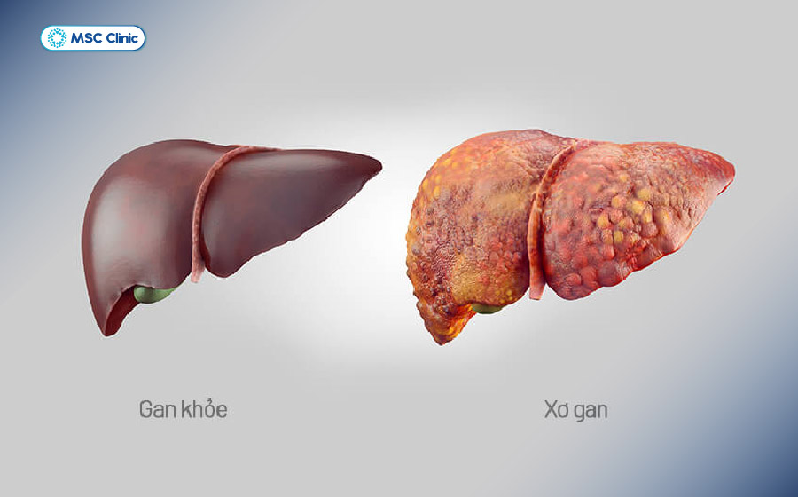 Bội nhiễm viêm gan D ở người mắc HBV mạn tính có thể dẫn tới xơ gan