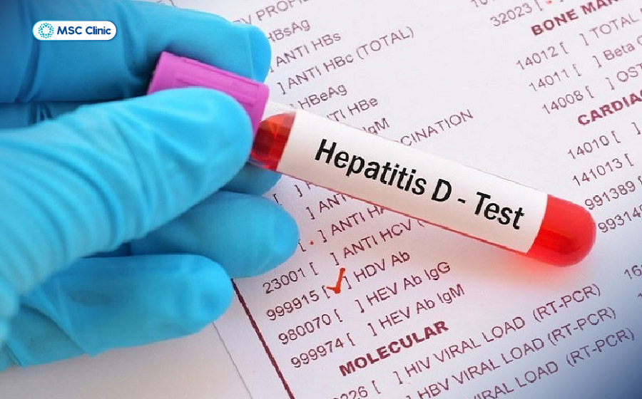 Xét nghiệm anti-HDV giúp phát hiện kháng thể chống virus viêm gan D