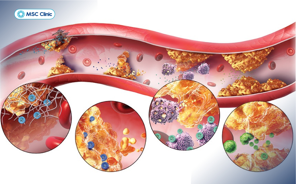 Rối loạn lipid máu làm tăng nguy cơ gan nhiễm mỡ, có thể tiến triển thành viêm gan mạn