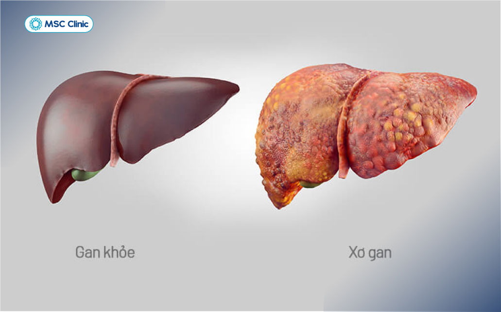 Hình ảnh so sánh giữa lá gan khỏe mạnh và lá gan bị xơ hóa