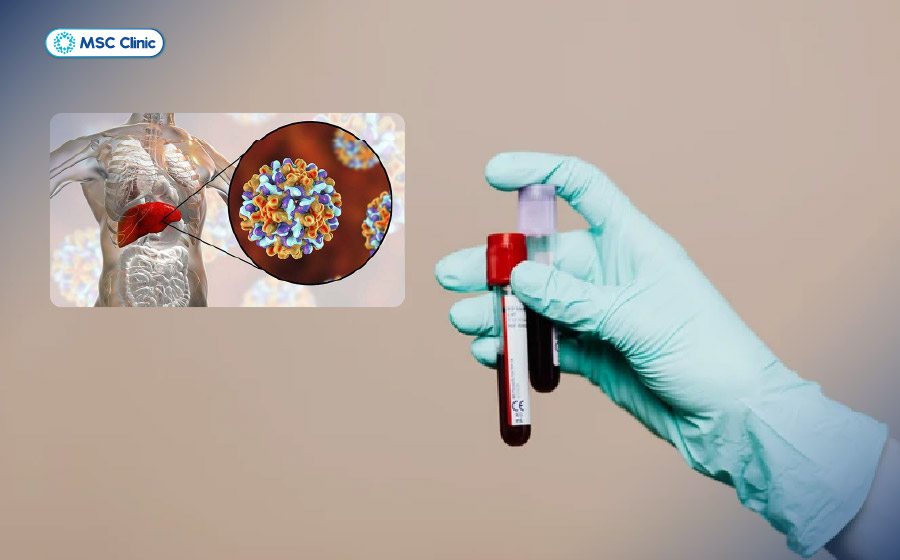 Xét nghiệm viêm gan A giúp xác định tình trạng nhiễm virus viêm gan A và miễn dịch của cơ thể