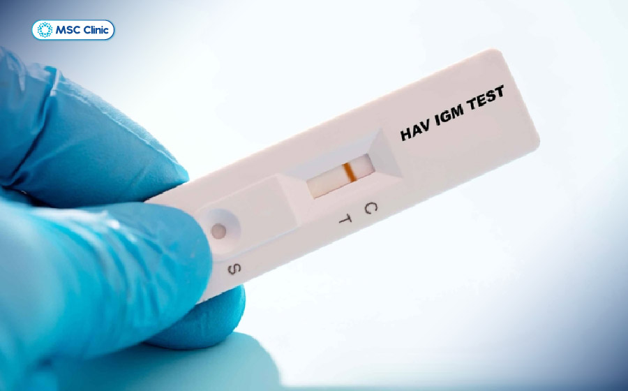 Anti-HAV IgM là dấu ấn quan trọng trong chẩn đoán viêm gan A cấp tính