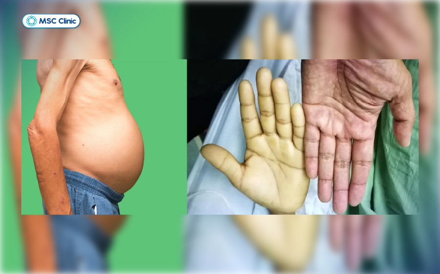 Vàng da, cổ trướng có thể là triệu chứng của viêm gan B đã tiến triển nặng