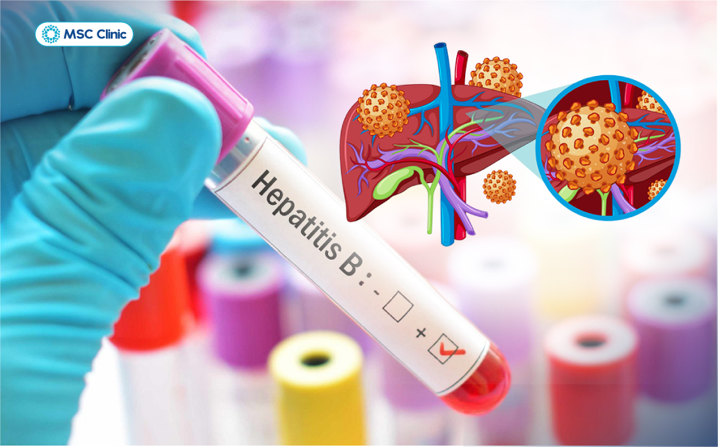 Xét nghiệm viêm gan B giúp xác định tình trạng nhiễm virus và khả năng miễn dịch của cơ thể 