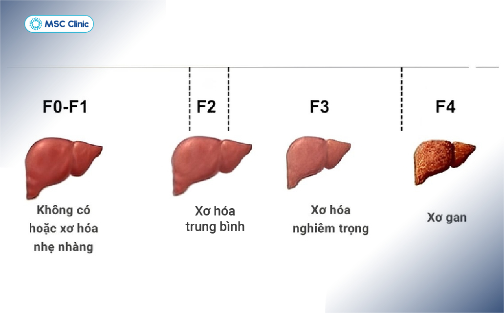 Xơ gan F2 là giai đoạn gan đã xuất hiện mô sẹo ở mức độ trung bình nhưng chưa tiến triển thành xơ gan thực sự