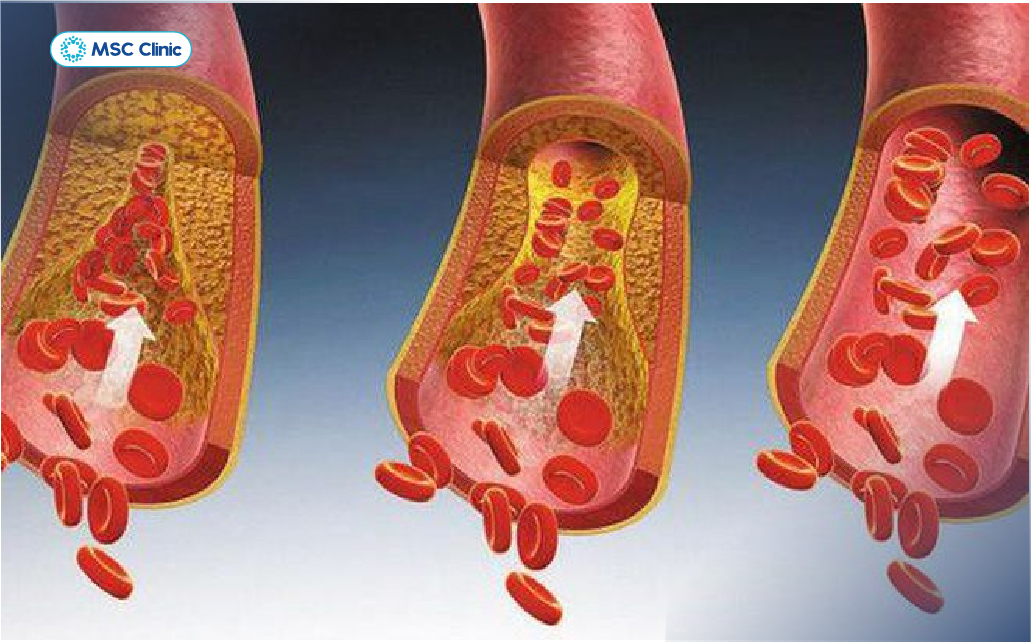 Rối loạn chuyển hóa mỡ gây tổn thương tế bào gan và có thể tiến triển thành xơ gan F2