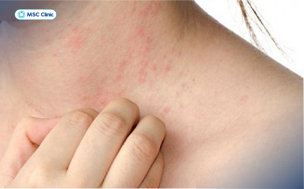 Xơ gan giai đoạn đầu thường không có dấu hiệu cụ thể cho tới khi bệnh tiến triển đến giai đoạn nặng