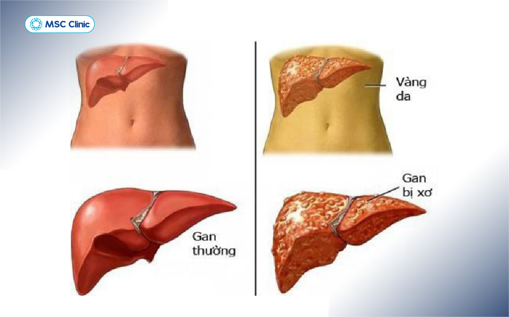 Chức năng gan suy giảm dẫn đến hàng loạt các vấn đề về sức khỏe