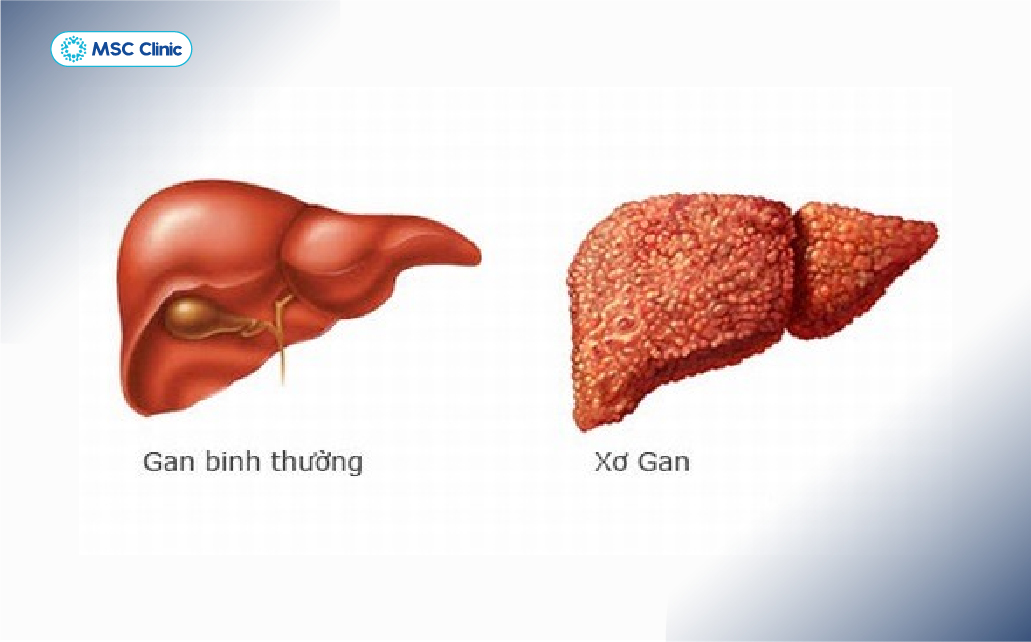 So sánh mô gan bình thường và mô gan xơ ở người xơ gan còn bù
