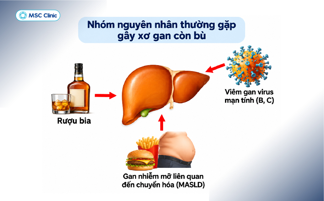 Những nguyên nhân thường gặp gây xơ gan