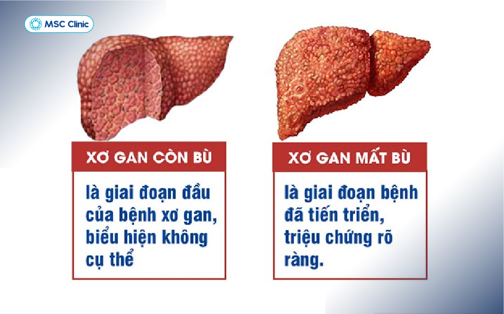 Xơ gan còn bù có thể tiến triển sang mất bù nếu nguyên nhân không được kiểm soát