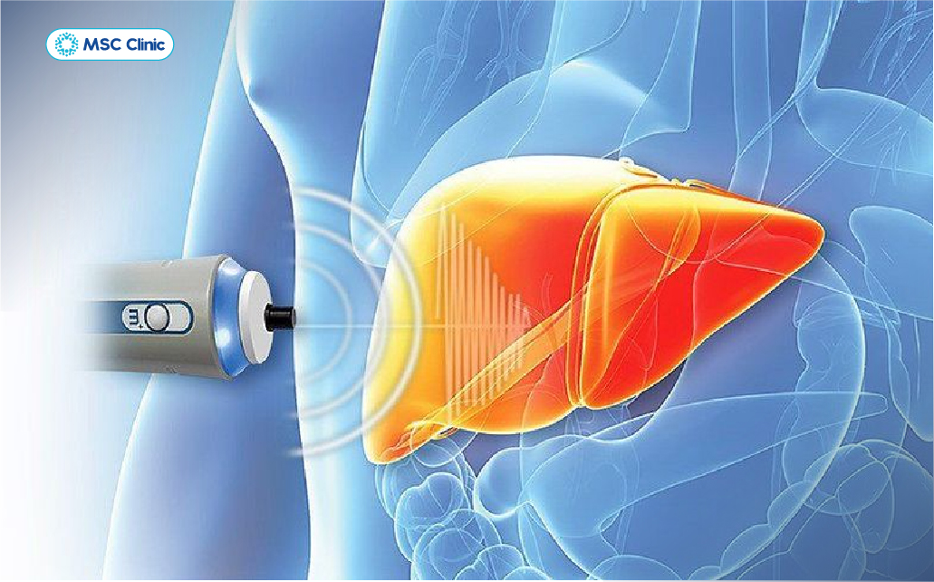 FibroScan hỗ trợ đánh giá mức độ xơ hóa gan bằng phương pháp không xâm lấn