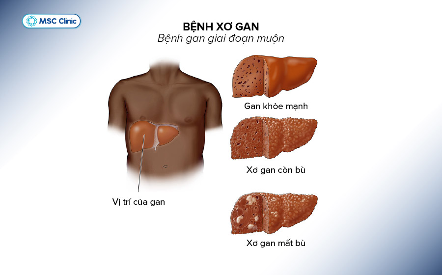 Các giai đoạn của xơ gan