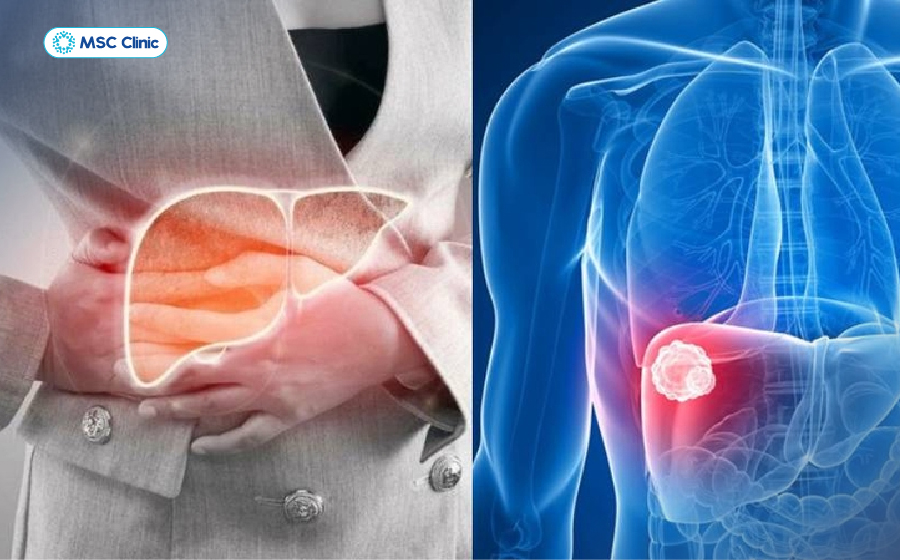 Cảm giác đau tức hoặc khó chịu vùng hạ sườn phải là một trong những dấu hiệu xơ gan giai đoạn đầu