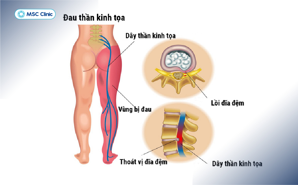 Dấu hiệu thoát vị đĩa đệm mông là biểu hiện lâm sàng ban đầu của tình trạng viêm, chèn ép thần kinh tọa Dấu hiệu thoát vị đĩa đệm mông là biểu hiện lâm sàng ban đầu của tình trạng viêm, chèn ép thần kinh tọa