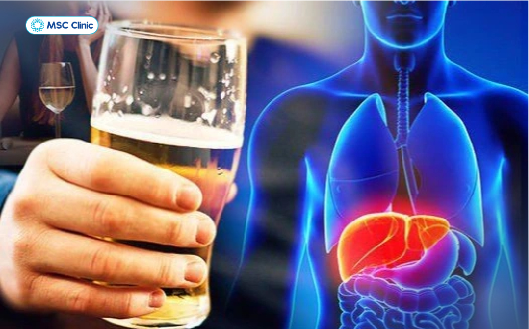 Đồ uống có cồn là thực phẩm cần loại bỏ đầu tiên trong danh sách “Bị viêm gan B kiêng ăn gì”