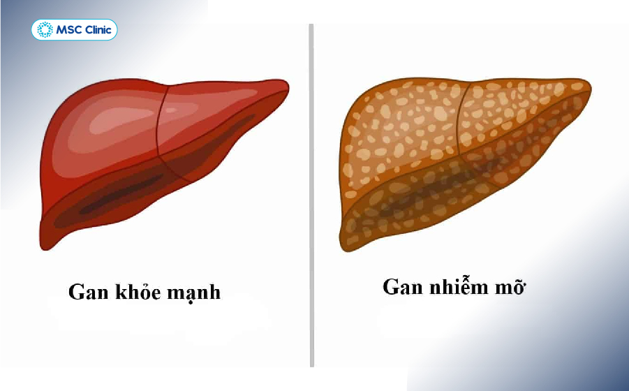 Gan nhiễm mỡ là tình trạng chất béo tích tụ quá mức trong tế bào gan Gan nhiễm mỡ là tình trạng chất béo tích tụ quá mức trong tế bào gan