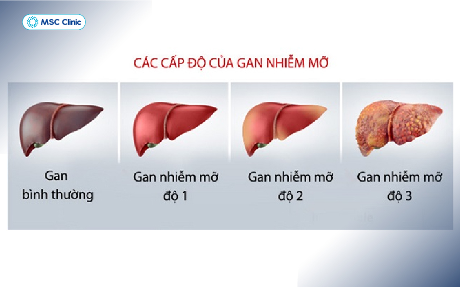 Gan nhiễm mỡ tiến triển từ từ và thường không đi kèm những dấu hiệu cụ thể Gan nhiễm mỡ tiến triển từ từ và thường không đi kèm những dấu hiệu cụ thể