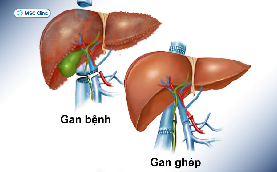 Ghép gan giúp thay thế lá gan tổn thương nghiêm trọng, mở ra hy vọng phục hồi cho bệnh nhân xơ gan mất bù 