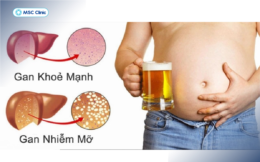 Người thường xuyên sử dụng chất kích thích, đồ uống có cồn cần chú ý kiểm tra sức khỏe gan định kỳ Người thường xuyên sử dụng chất kích thích, đồ uống có cồn cần chú ý kiểm tra sức khỏe gan định kỳ
