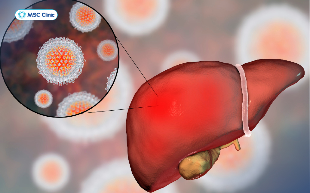 Phản ứng quá mức của hệ miễn dịch trước virus HBV đã gây viêm và tổn thương tế bào gan