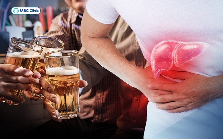 Rượu bia là một trong những nguyên nhân hàng đầu gây tổn thương gan và diễn tiến đến xơ gan