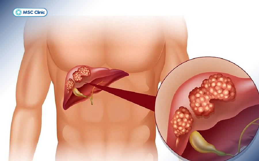 Suy gan mạn tính xảy ra khi chức năng gan suy giảm kéo dài, ảnh hưởng đến nhiều hoạt động chuyển hóa quan trọng của cơ thể