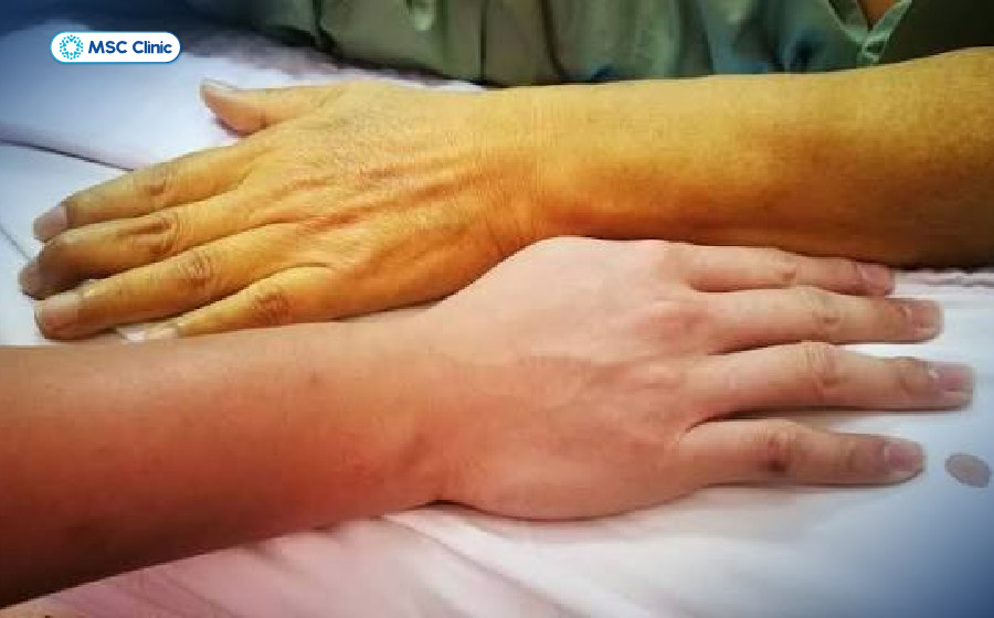 Vàng da, bụng to do cổ trướng và phù chân có thể xuất hiện khi bệnh gan mạn tính đã tiến triển