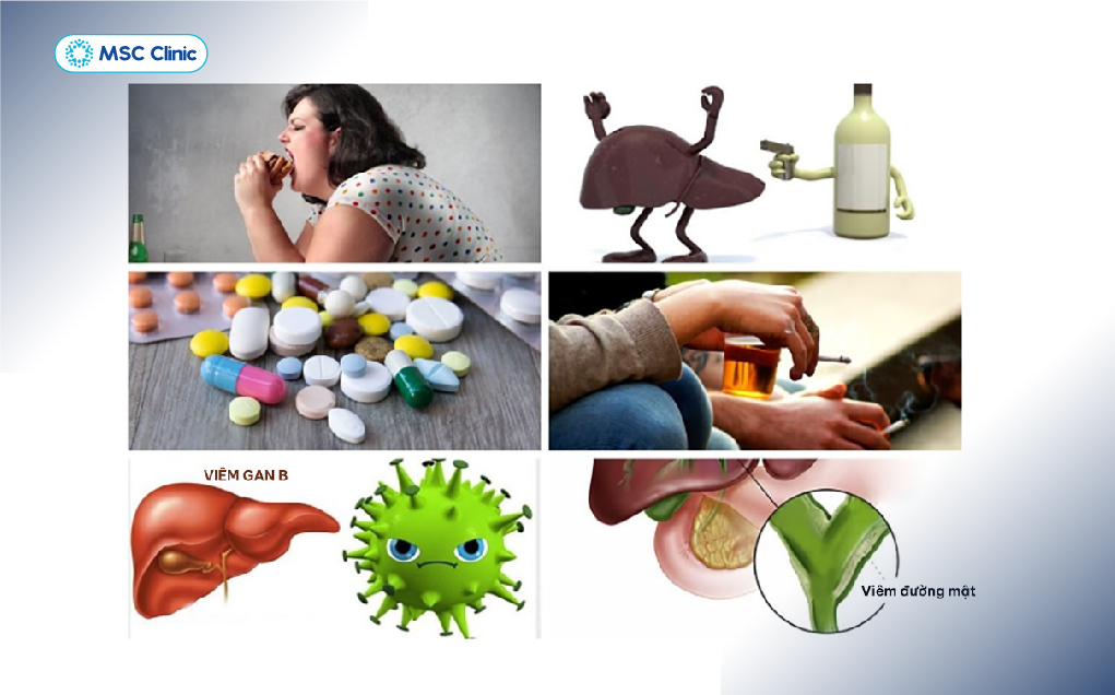 Viêm gan virus, sử dụng rượu bia kéo dài và bệnh gan liên quan đến rối loạn chuyển hóa là những nguyên nhân có thể dẫn đến xơ gan