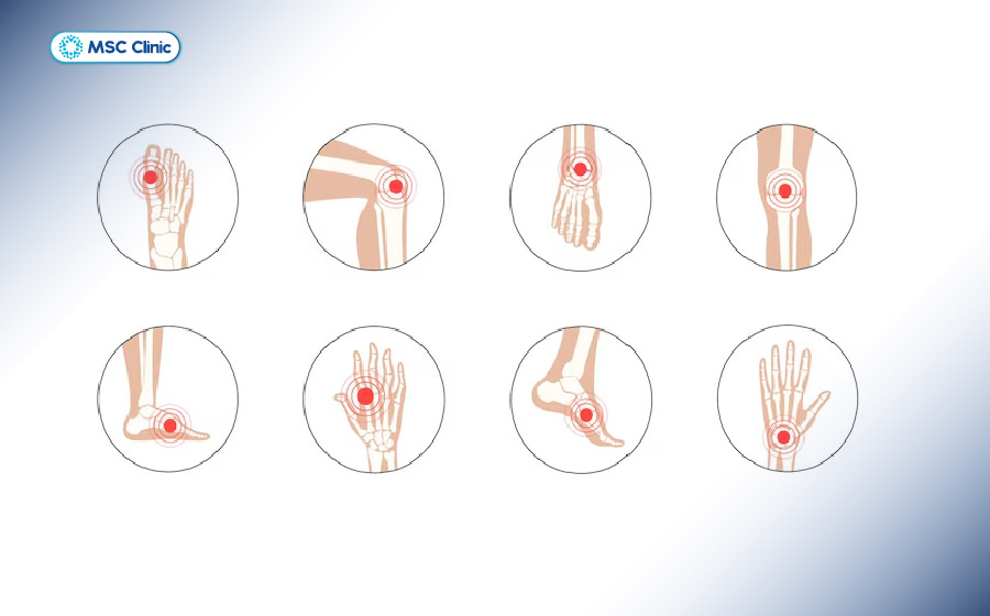 Viêm khớp không đặc hiệu là tình trạng khớp đã có viêm nhưng chưa xác định được bệnh lý cụ thể Viêm khớp không đặc hiệu là tình trạng khớp đã có viêm nhưng chưa xác định được bệnh lý cụ thể
