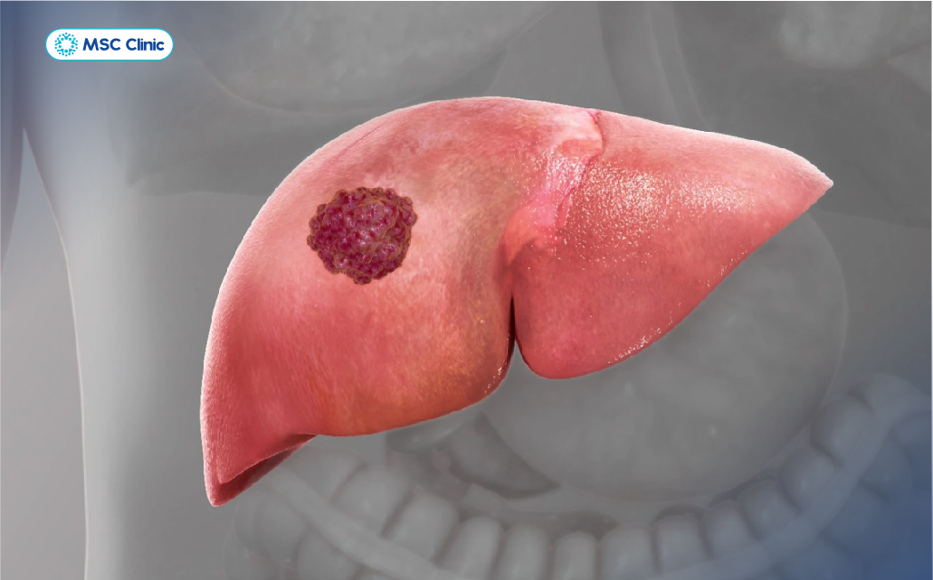 Virus viêm gan B nhân lên liên tục không được kiểm soát có thể dẫn tới ung thư gan