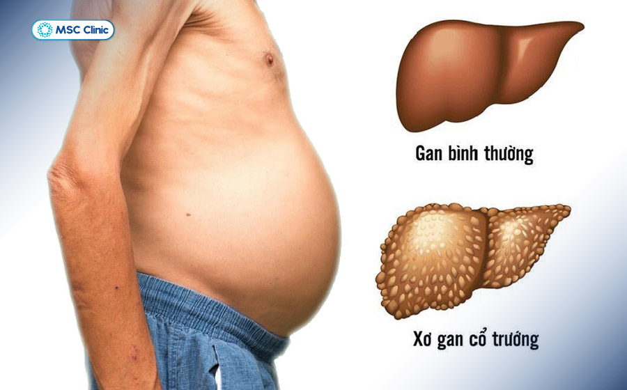 Xơ gan cổ trướng cần được can thiệp kịp thời để không ảnh hưởng đến tính mạng của người bệnh