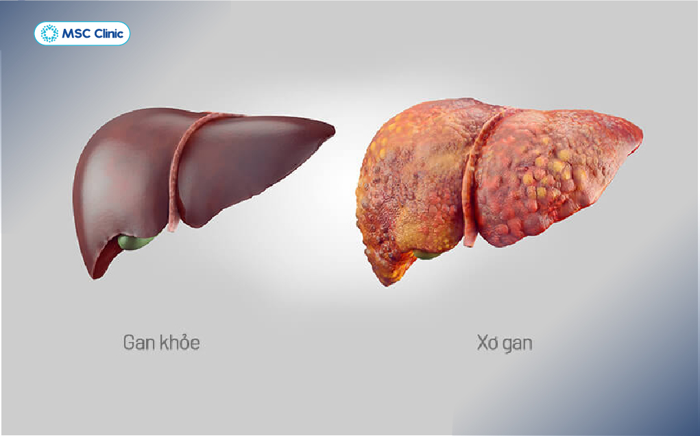 Xơ gan làm giảm nghiêm trọng khả năng tổng hợp protein, chuyển hóa chất, giải độc và điều hòa đông máu của cơ thể